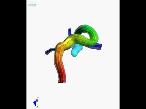 Blood flow analysis about a real cerebral aneurysm