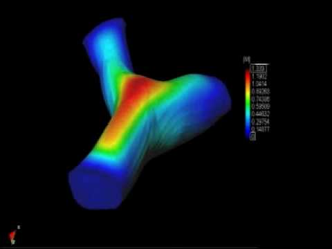 Blood flow of a carotid bifurcation, fluid-structure interactio